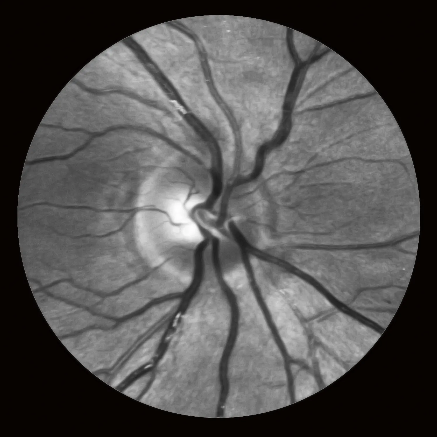 Retina